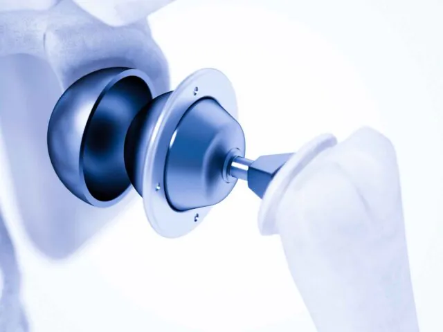 biomaterials_prothese
